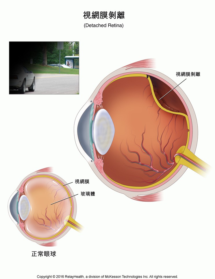 Retinal Detachment: Illustration