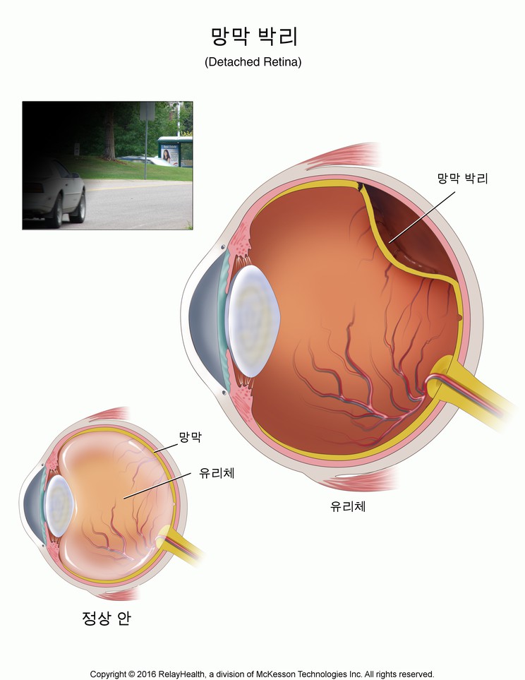 Retinal Detachment: Illustration