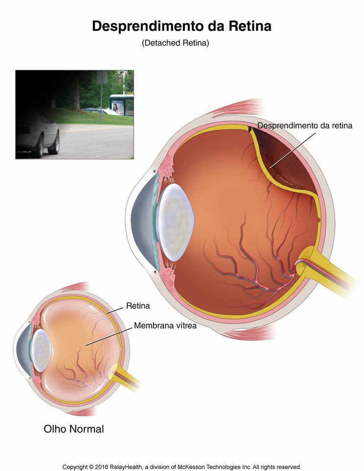 Retinal Detachment: Illustration