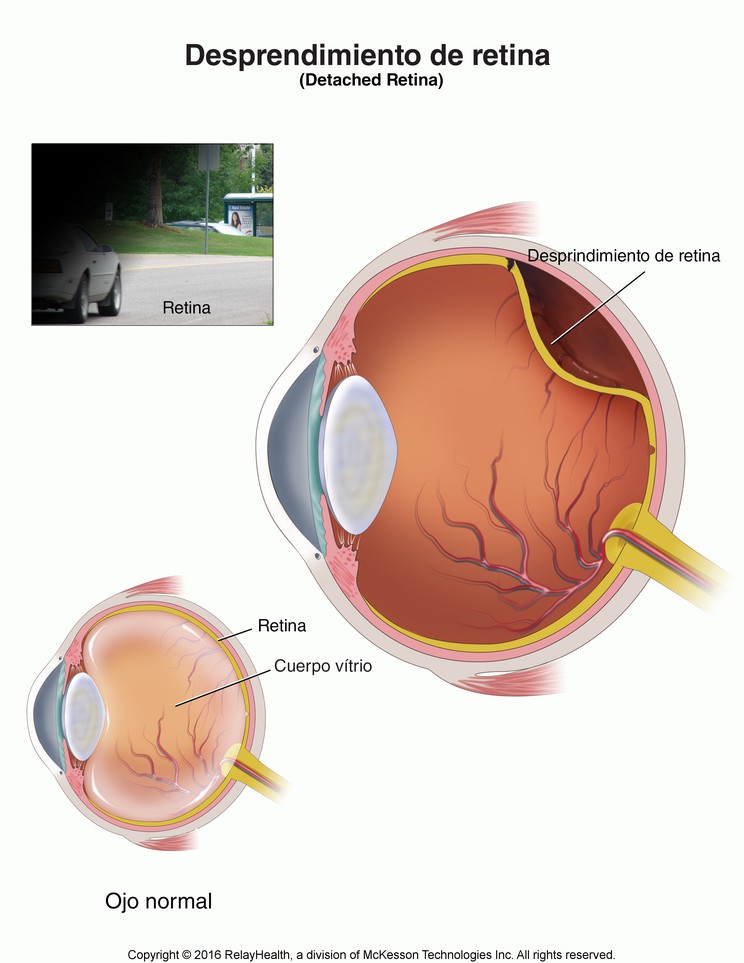 Retinal Detachment: Illustration