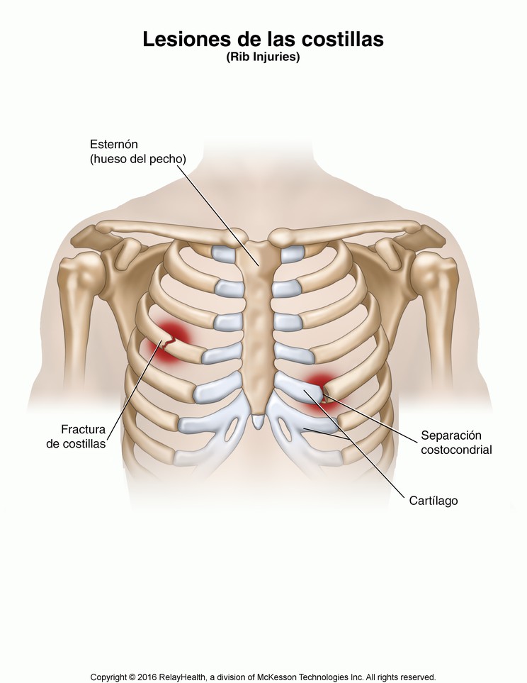 Rib Injuries: Illustration