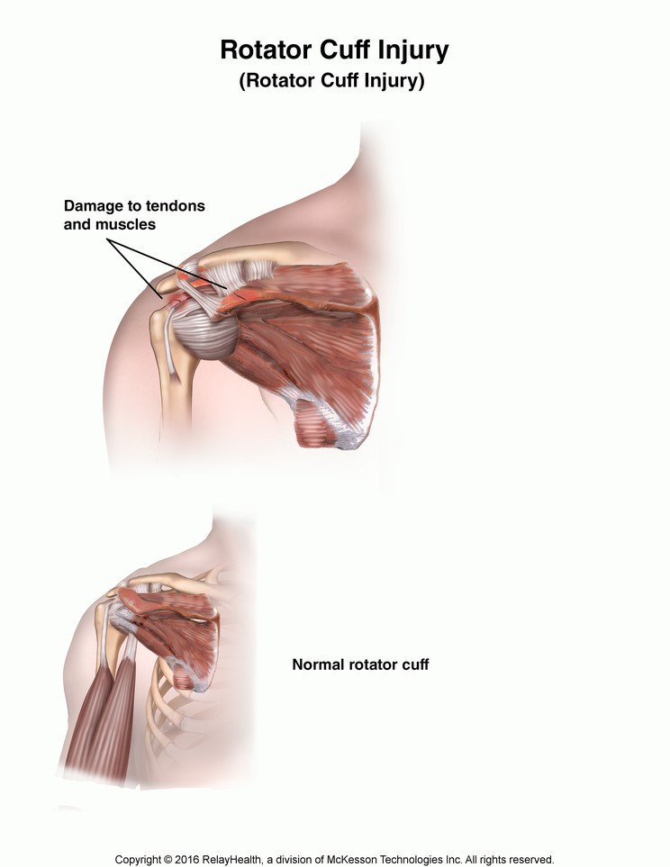 Rotator Cuff Injury: Illustration