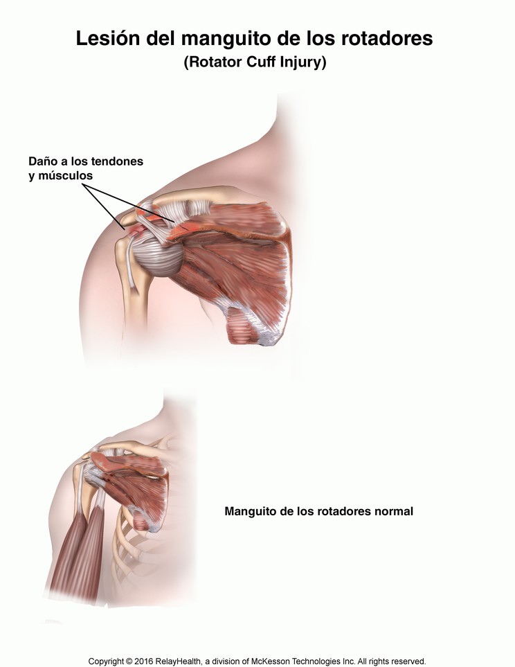 Rotator Cuff Injury: Illustration