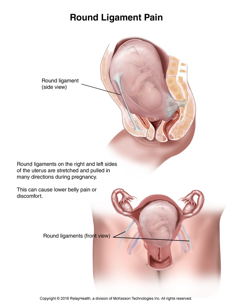 Round Ligament Pain: Illustration