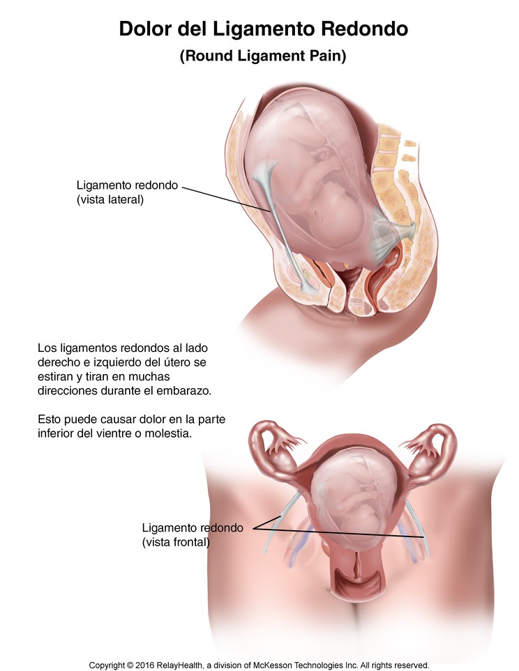Round Ligament Pain: Illustration
