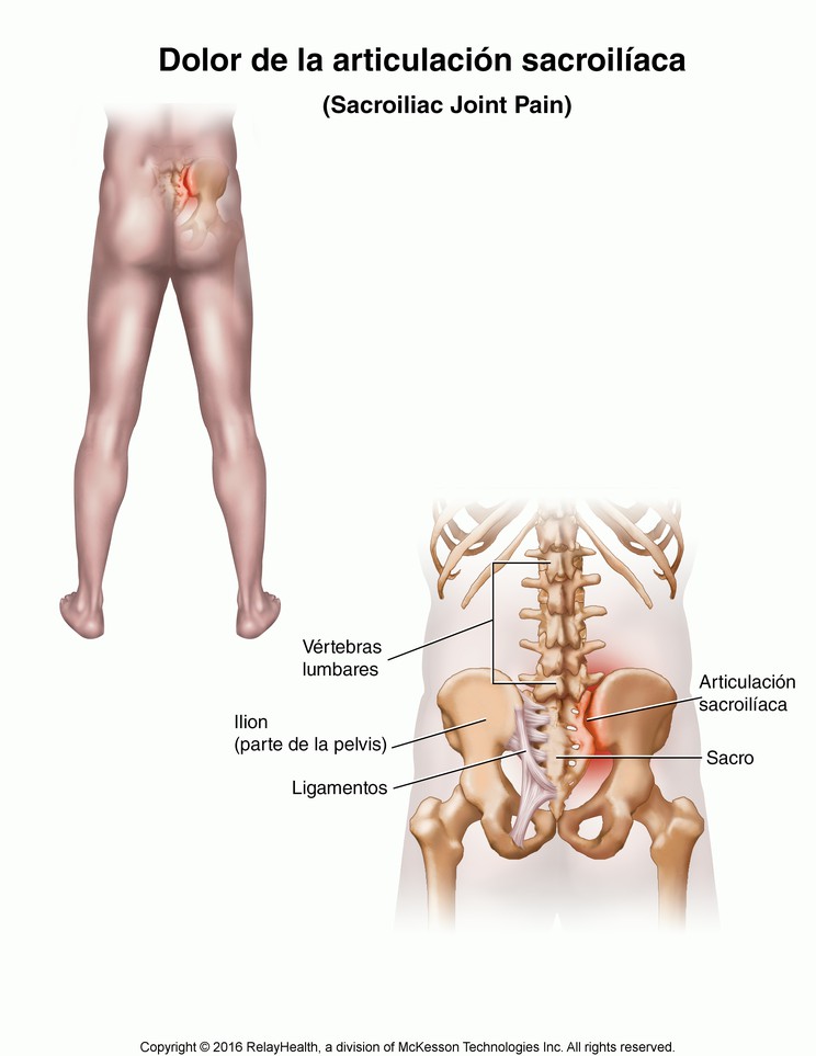 Sacroiliac Joint Pain: Illustration
