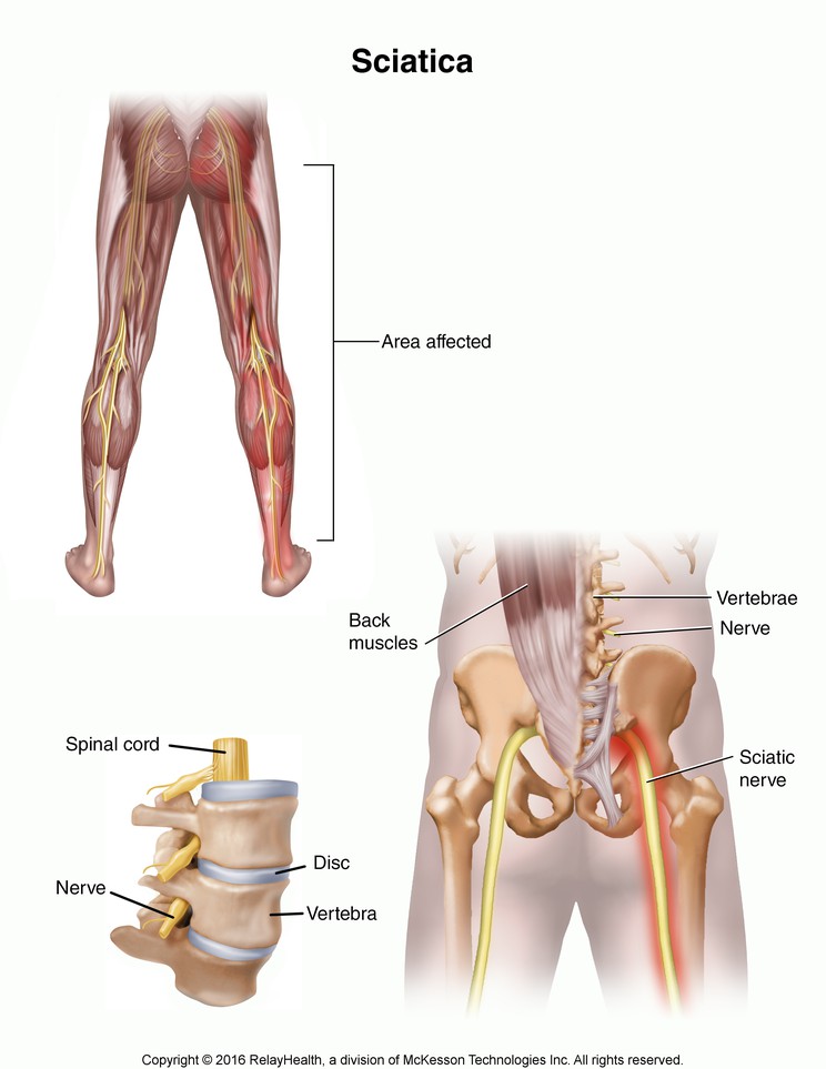 Sciatica: Illustration