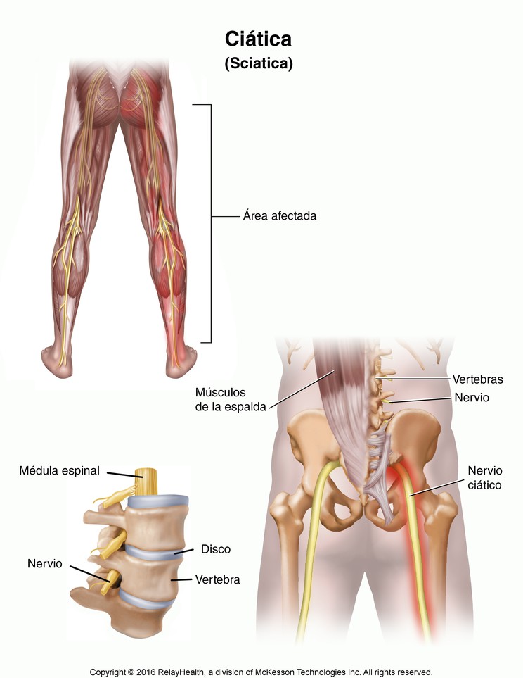 Sciatica: Illustration