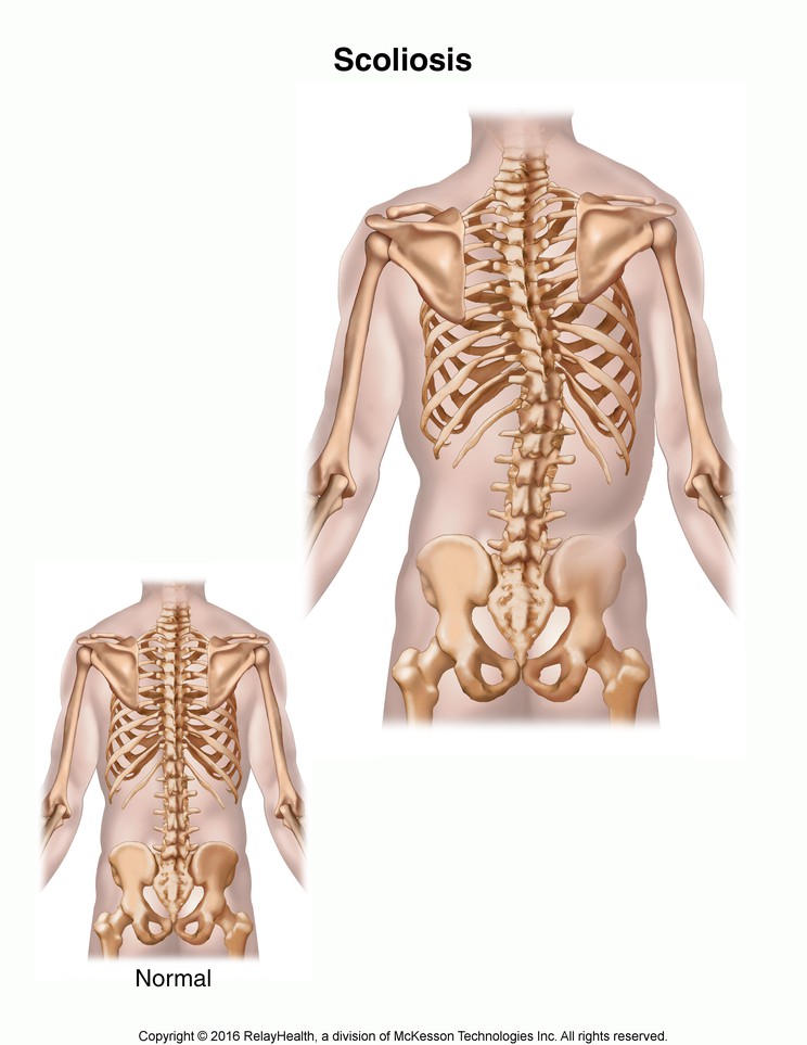 Scoliosis: Illustration