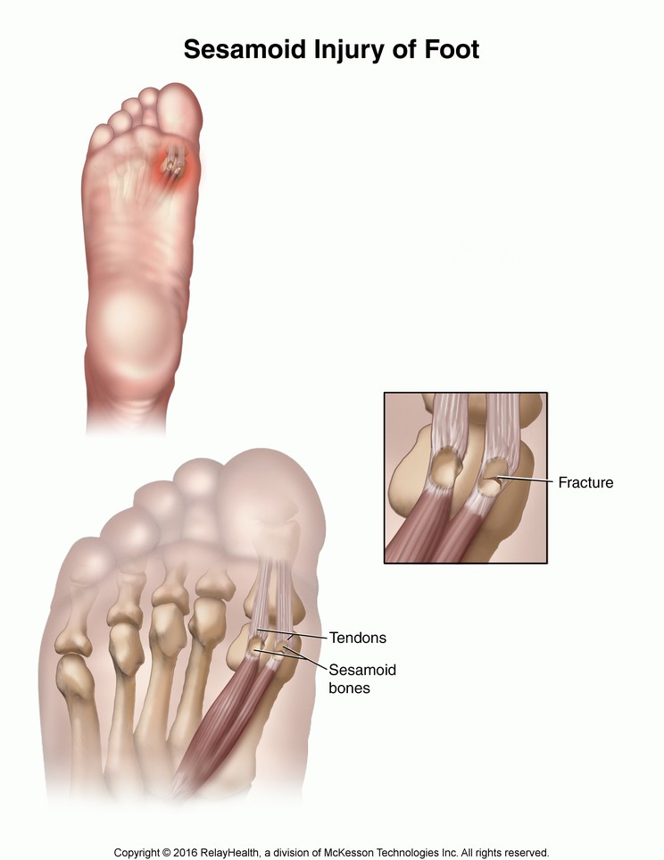 Sesamoid Injury of the Foot: Illustration