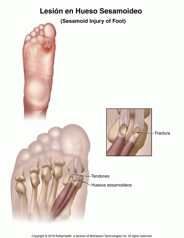 Sesamoid Injury of the Foot: Illustration