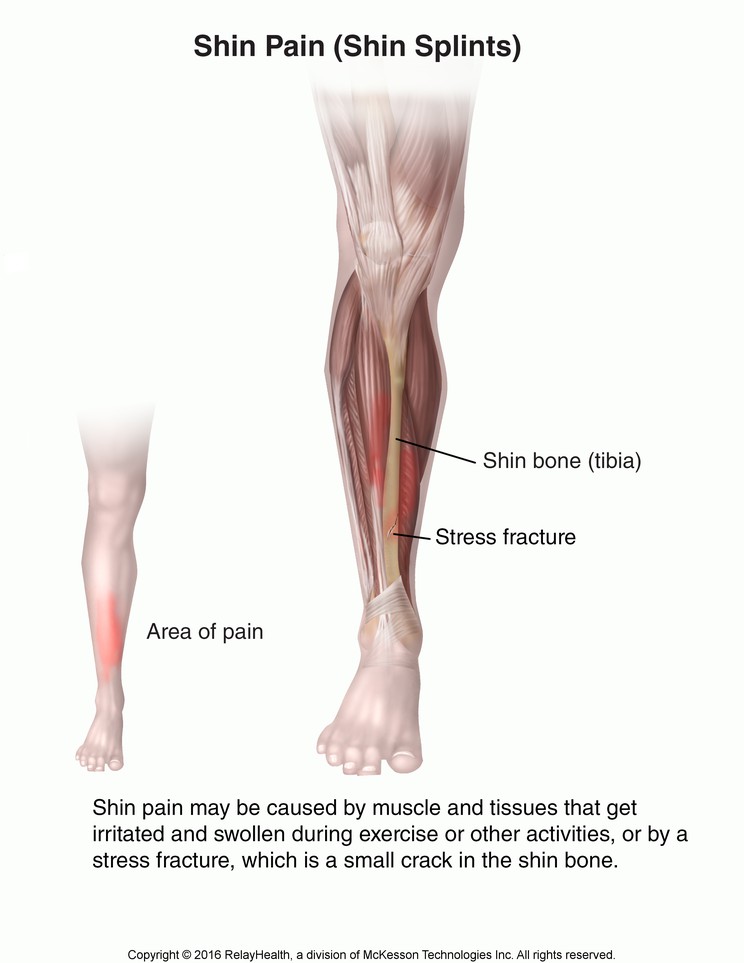 Shin Pain (Shin Splints): Illustration
