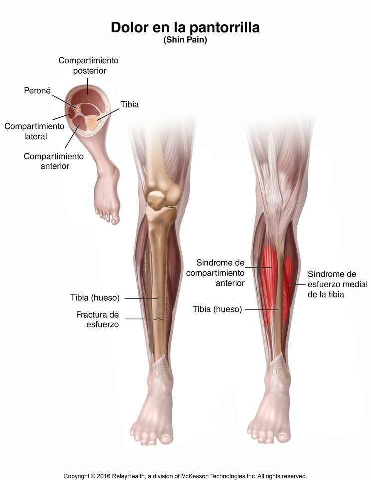 Shin Pain (Shin Splints): Illustration