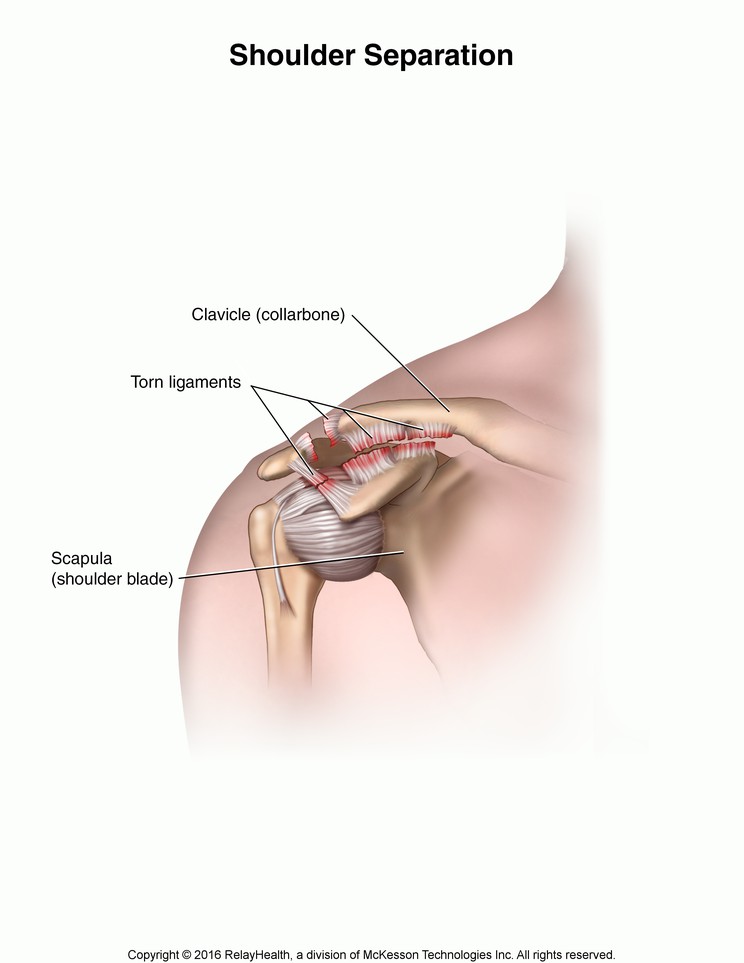 Shoulder Separation: Illustration