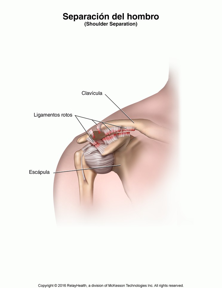 Shoulder Separation: Illustration