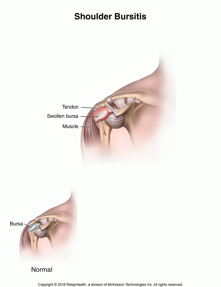 Shoulder Bursitis: Illustration