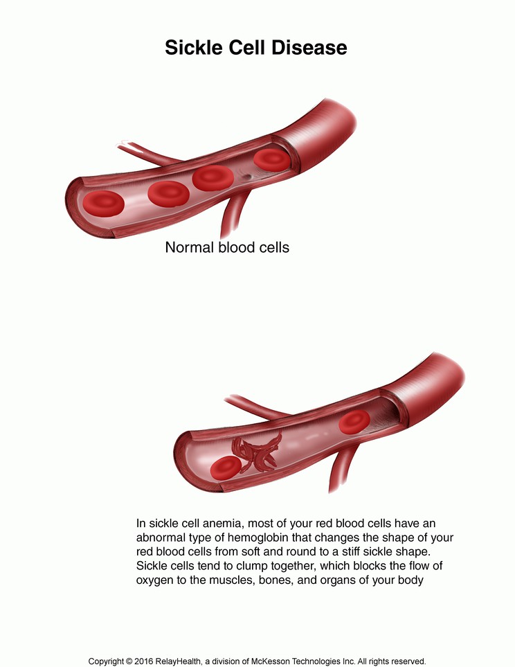 Sickle Cell Anemia: Illustration