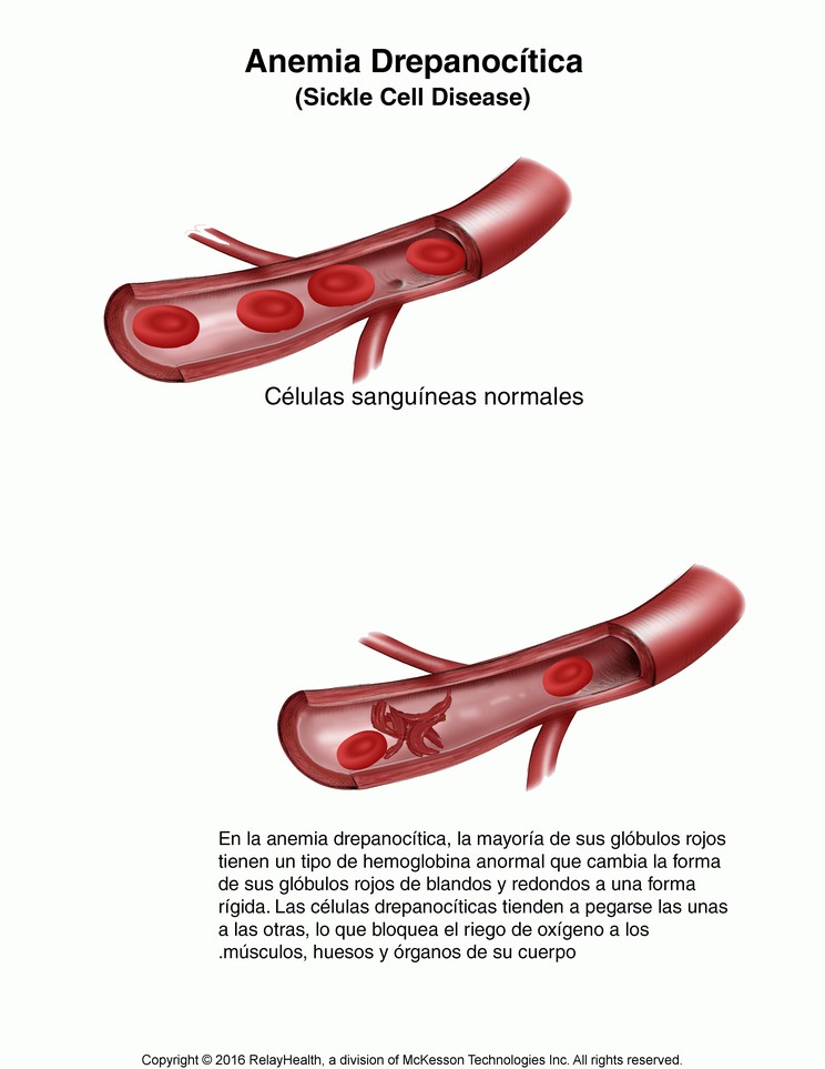 Sickle Cell Anemia: Illustration