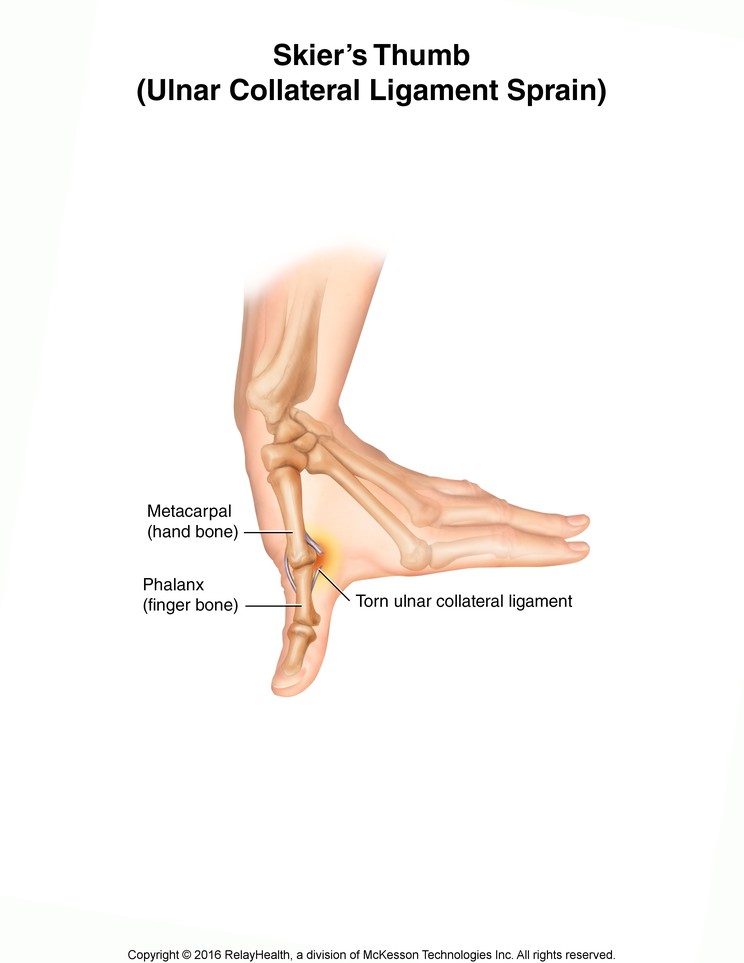 Skier's Thumb (Ulnar Collateral Ligament Sprain): Illustration