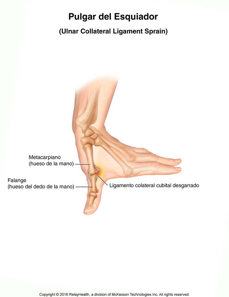 Skier's Thumb (Ulnar Collateral Ligament Sprain): Illustration