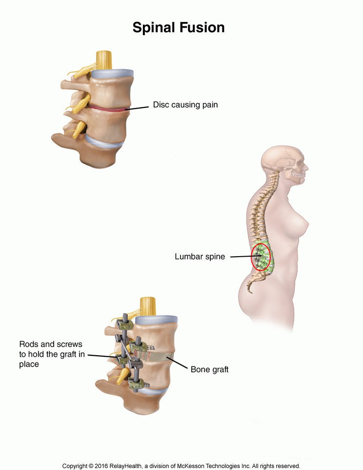 Spinal Fusion: Illustration