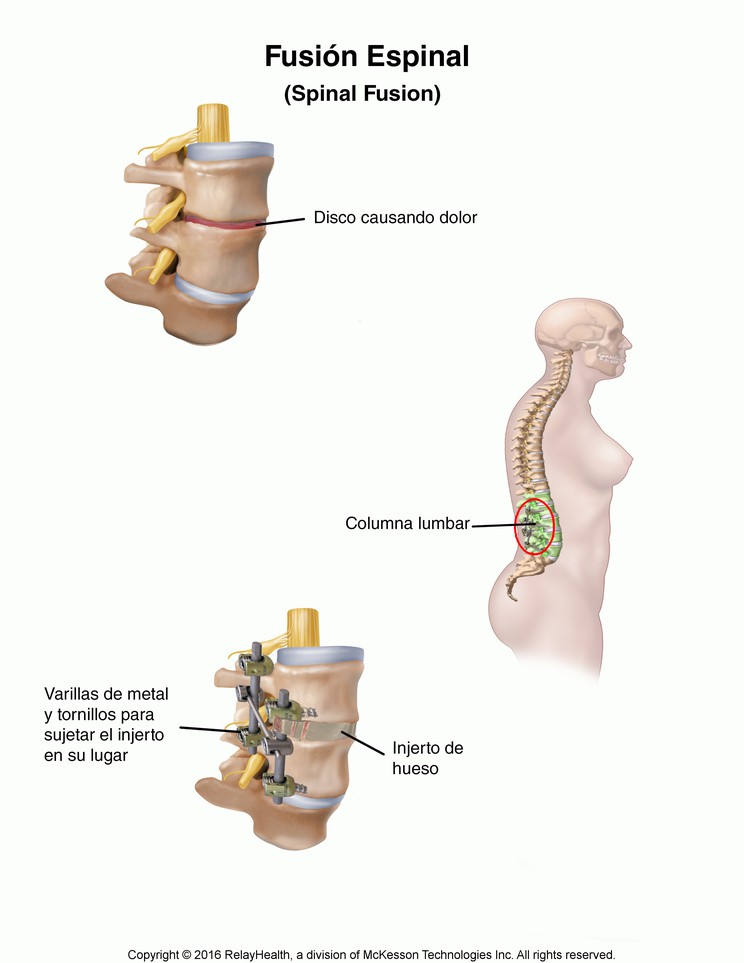 Spinal Fusion: Illustration