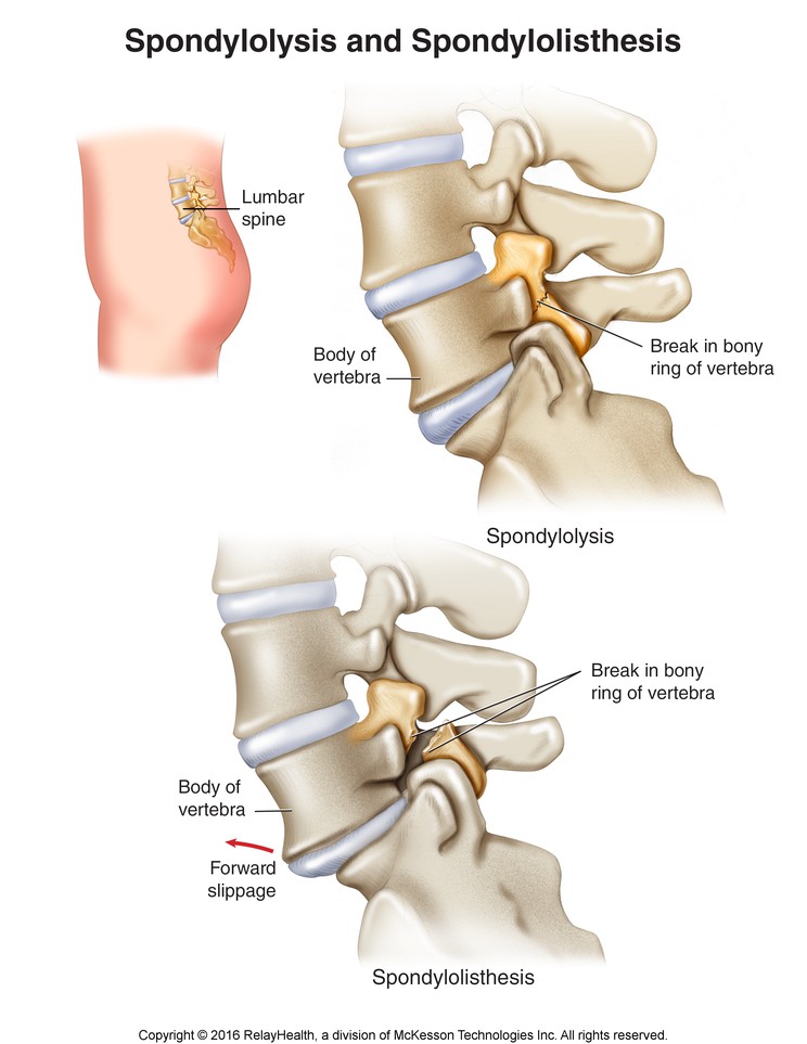 Spondylolysis and Spondylolisthesis: Illustration
