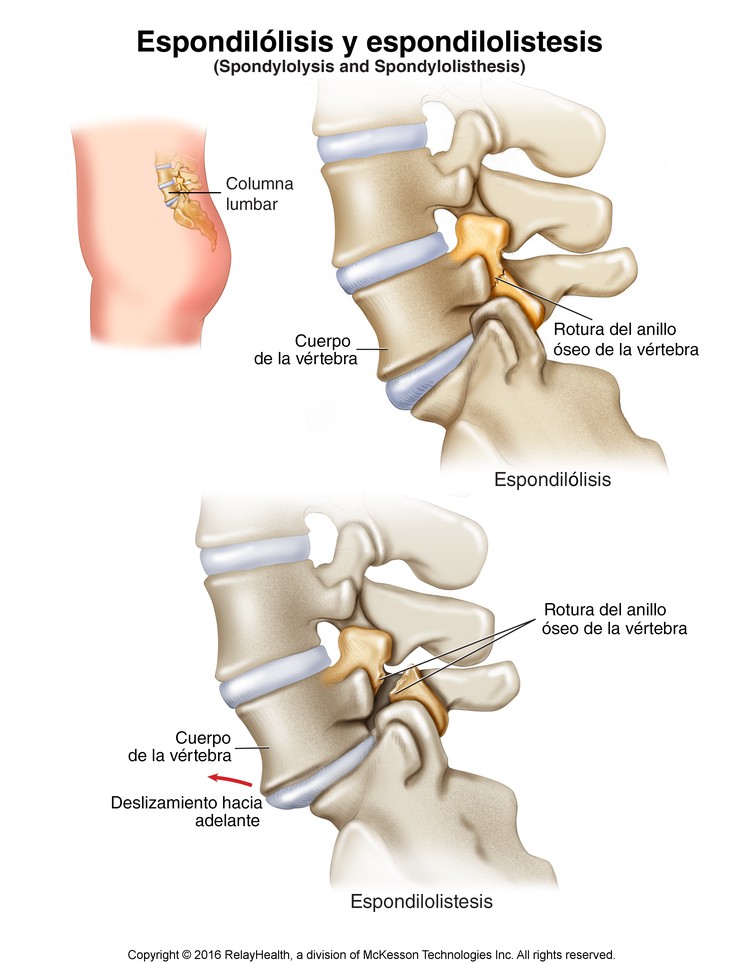 Spondylolysis and Spondylolisthesis: Illustration