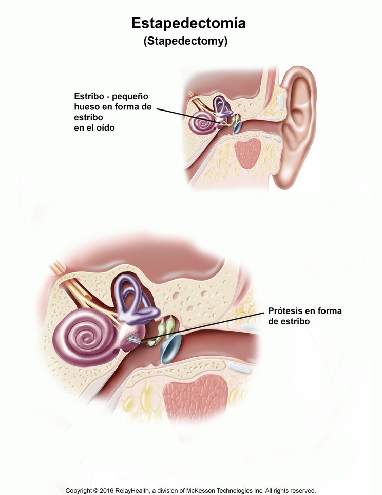 Stapedectomy: Illustration