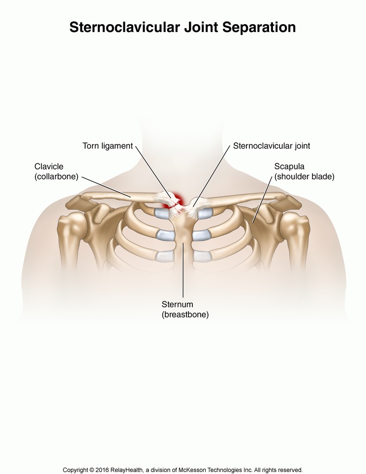 Sternoclavicular Joint Separation: Illustration