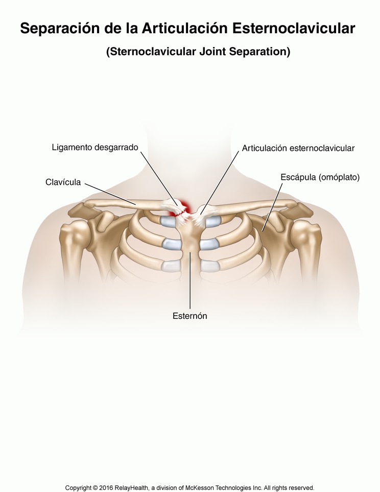 Sternoclavicular Joint Separation: Illustration