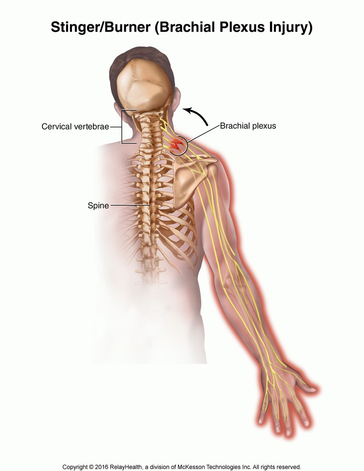 Stinger/Burner (Brachial Plexus Injury): Illustration