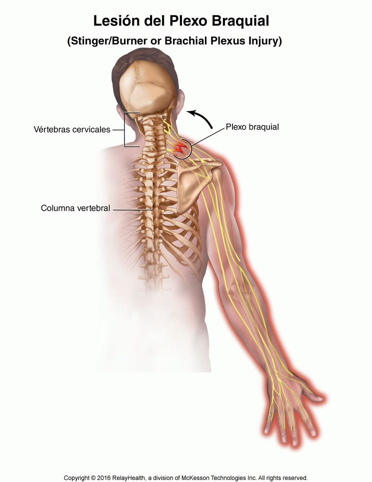 Stinger/Burner (Brachial Plexus Injury): Illustration
