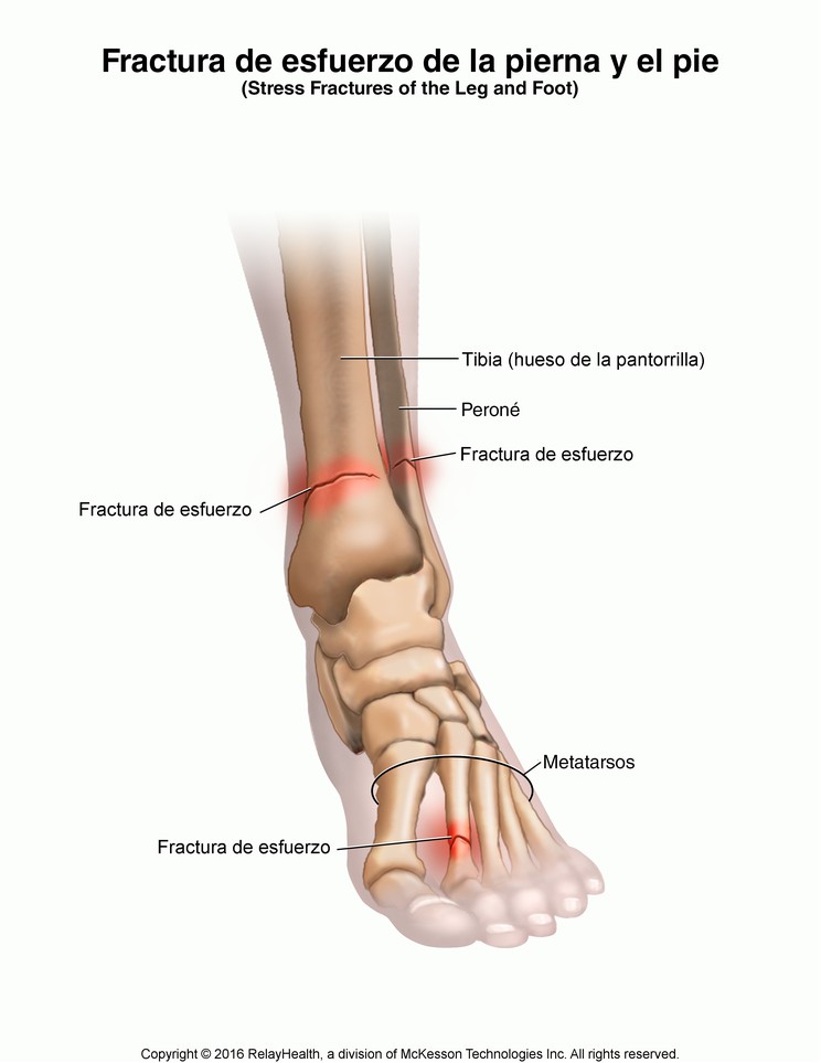 Stress Fractures of the Leg and Foot: Illustration