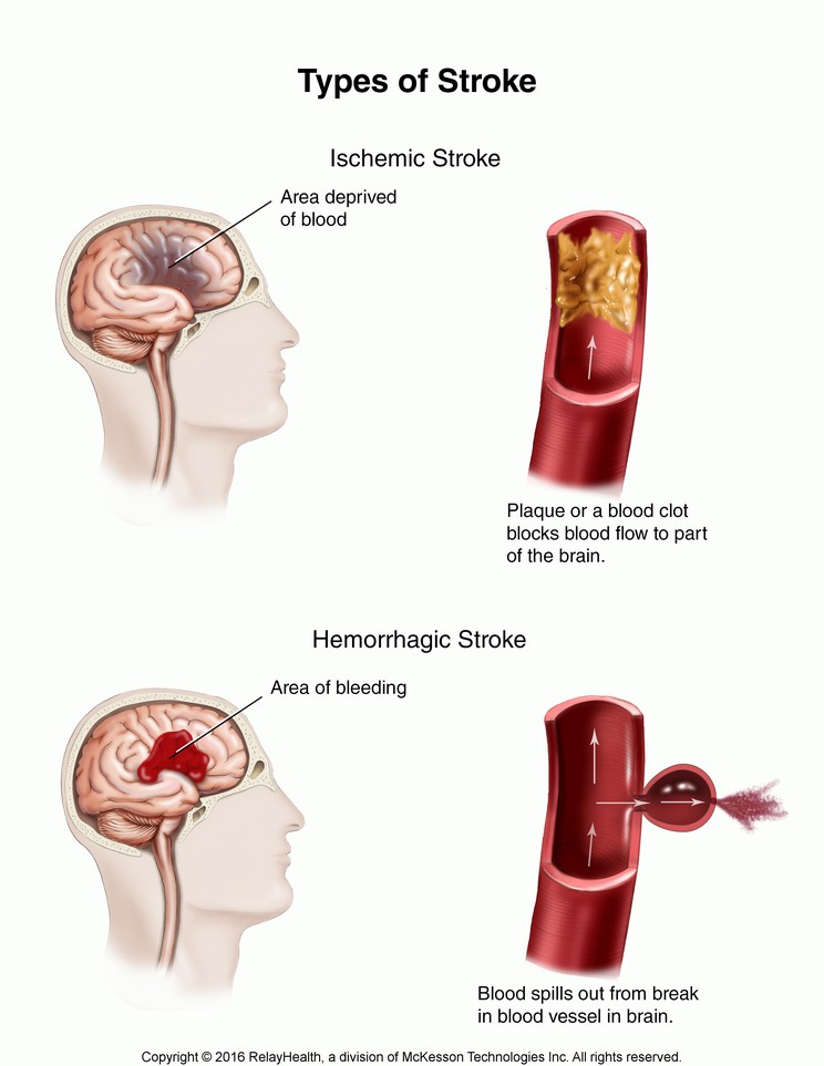 Types of Stroke: Illustration