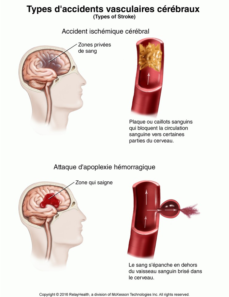 Stroke, Types of: Illustration