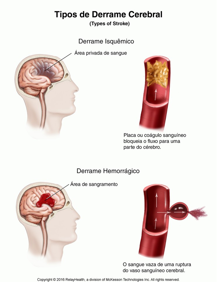 Stroke, Types of: Illustration
