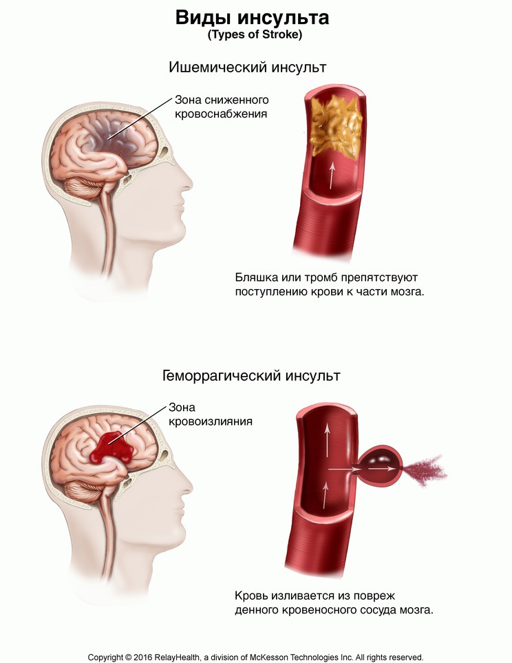 Stroke, Types of: Illustration