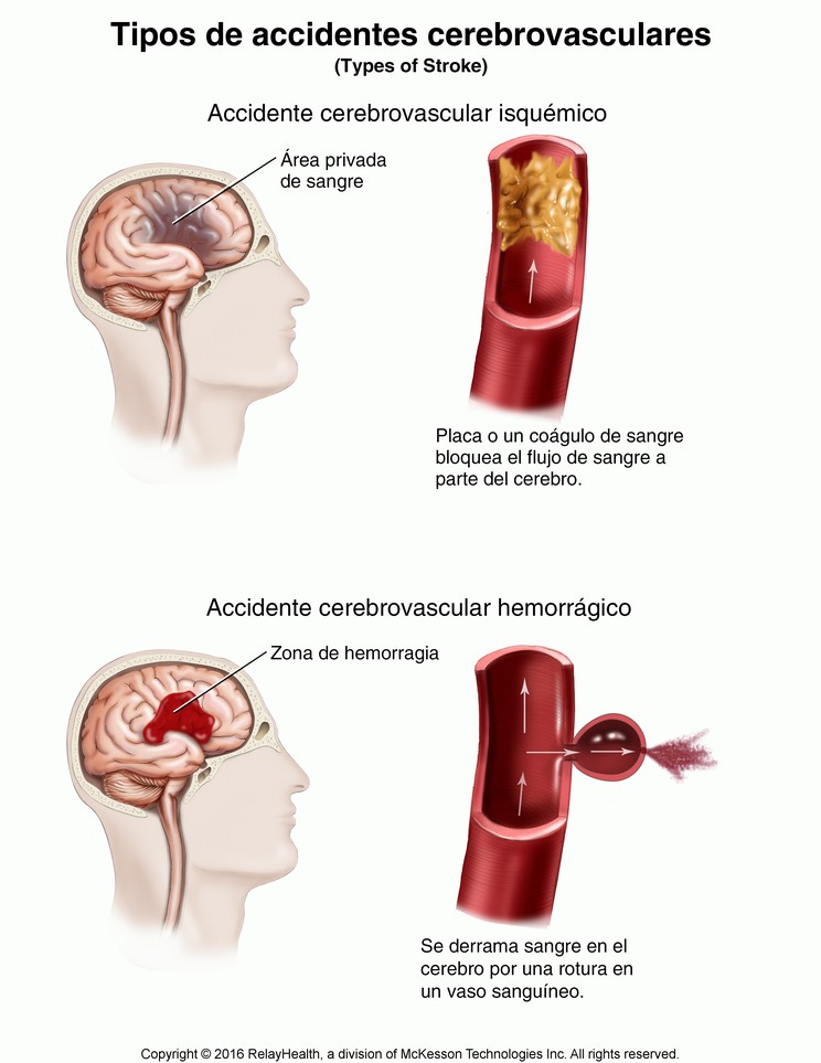 Stroke, Types of: Illustration