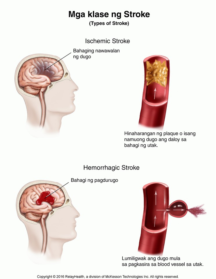 Stroke, Types of: Illustration