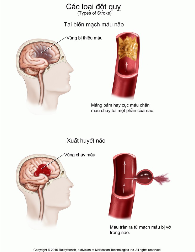 Stroke, Types of: Illustration