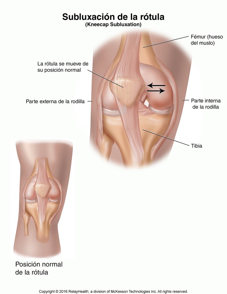 Kneecap Subluxation: Illustration