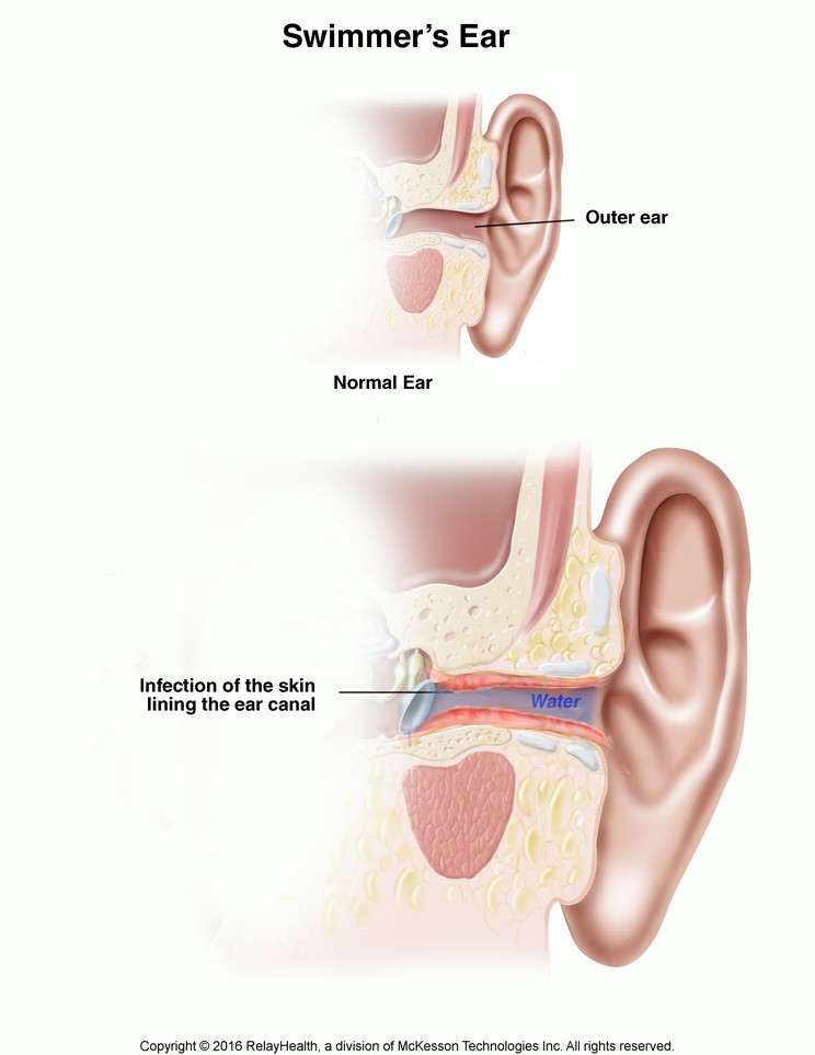 Swimmer's Ear: Illustration