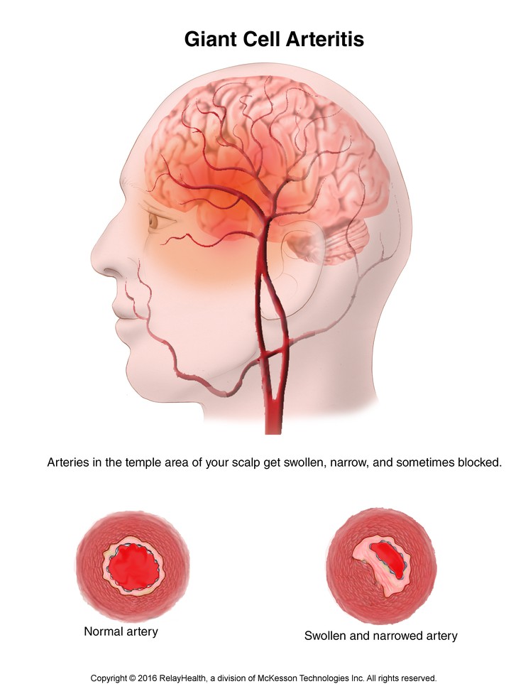 Giant Cell Arteritis: Illustration