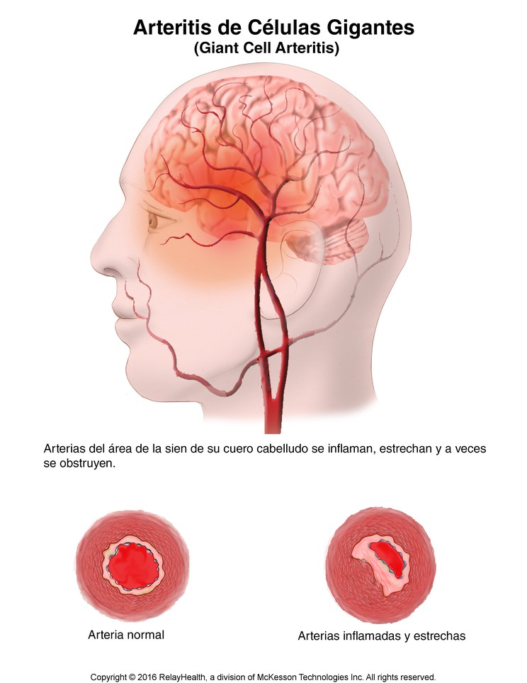 Giant Cell Arteritis: Illustration