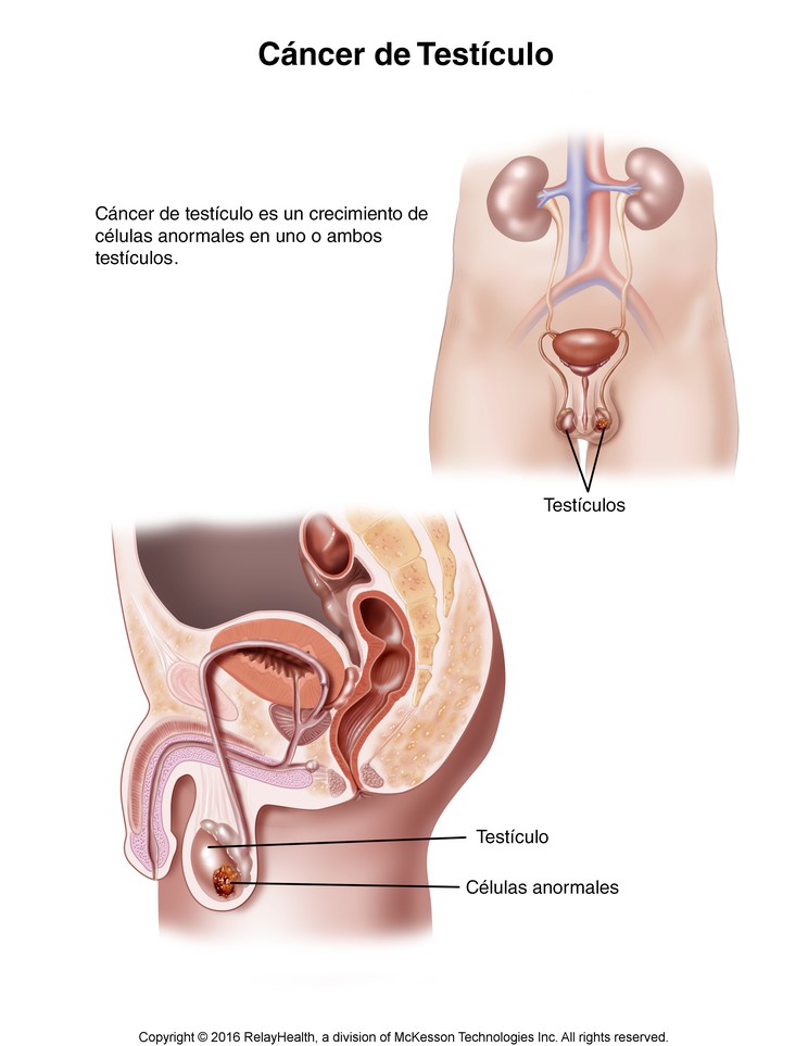 Testicular Cancer: Illustration