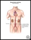 Thumbnail image of: Aortic Aneurysm: Illustration