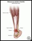 Thumbnail image of: Achilles Tendon Injury: Illustration