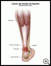 Thumbnail image of: Achilles Tendon Injury: Illustration