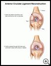 Thumbnail image of: Anterior Cruciate Ligament Reconstruction: Illustration